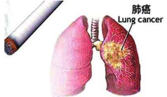 吸煙與肺癌的關(guān)系研究 與吸煙關(guān)系最為密切的肺癌是鱗癌